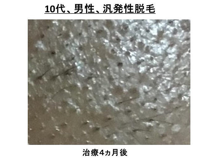 円形脱毛症　病院